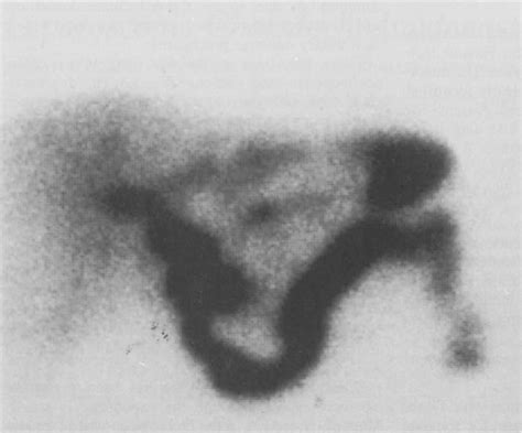 Figure 2 from Laparoscopic Choledochoduodenostomy | Semantic Scholar