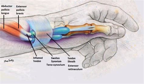 Figure_1_-_Tendons_of_the_abductor_pollicis_longus_and_extensor ...