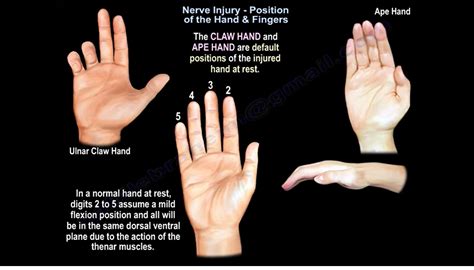 Ape Hand Deformity