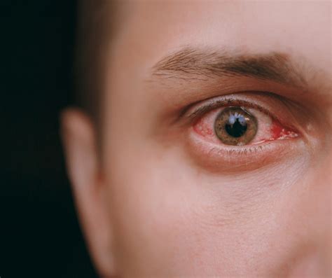 Causes and Treatments of Red Eyes - Phoenix Eye Doctors