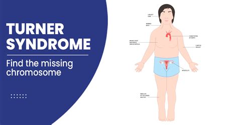 Turner’s syndrome – Types, Symptoms, Risk factors, and Treatments