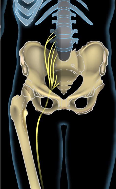 Sciatica - Wikipedia