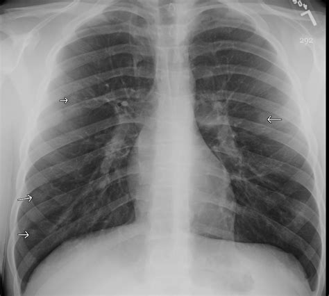 Pulmonary nodules - Cancer Therapy Advisor