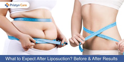 What to Expect After Liposuction Surgery? - Results From Before And ...