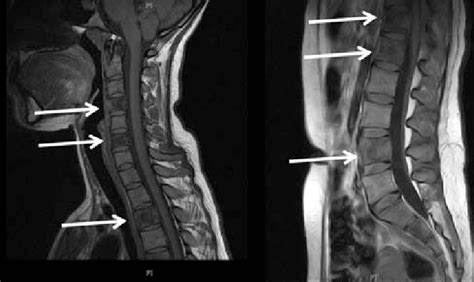 Thoracic Spine Mri Multiple Sclerosis