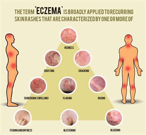 Pin on Brief Guidance on Different Types of Eczematous Dermatitis