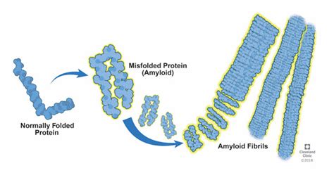 Amyloidosis Center | Cleveland Clinic