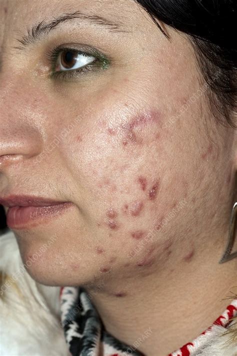 Acne vulgaris - Stock Image - C002/4056 - Science Photo Library