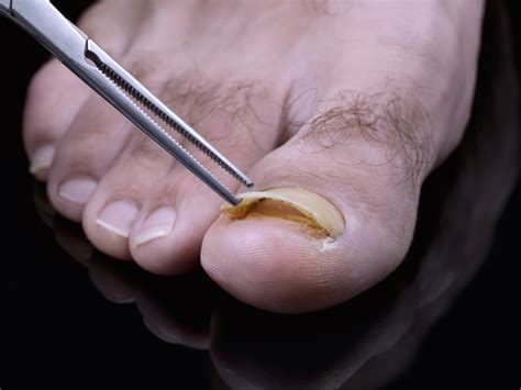 Toenail fungus treatment - Atlanta Podiatrists: Atlanta Foot and Ankle ...