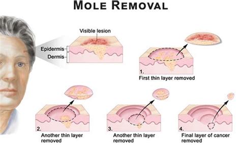 Mole Removal Specialist · 2016 Top Laser Dermatologist NYC