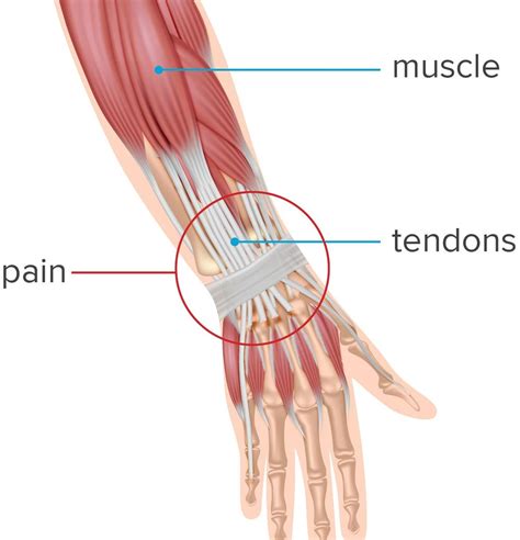 Wrist Tendonitis: Symptoms, Causes and Treatment SportsMD