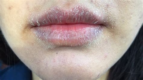 Contact Dermatitis Mouth