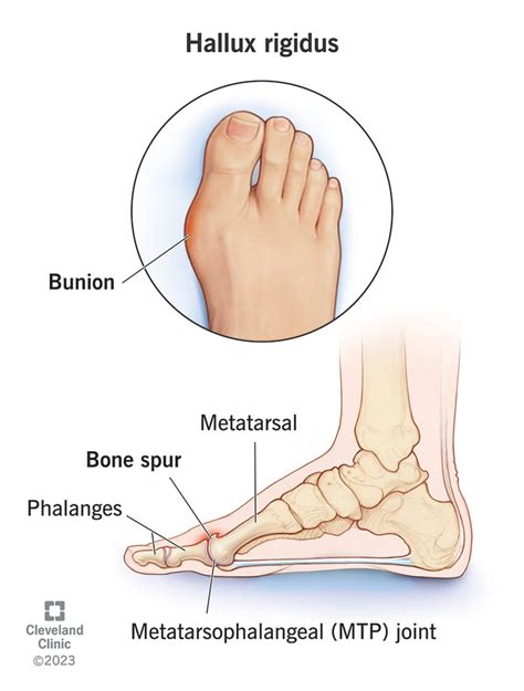 Hallux Rigidus Treatment: *Exercises, Inserts And Surgery*, 59% OFF