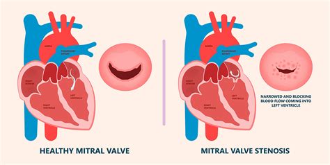 Mitral Valve Diseases Types, Symptoms and Treatment| Dr Raghu