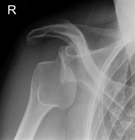 Shoulder Dislocation X Ray Images and Treatments | New Health Advisor