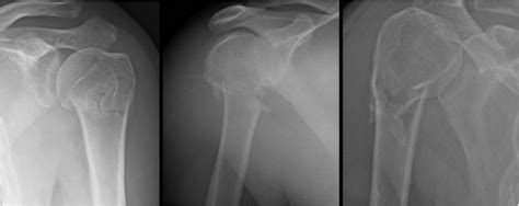 Proximal Humerus Fracture X Ray