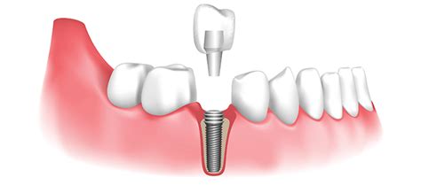 Dental Implant Procedures - American Academy of Periodontology