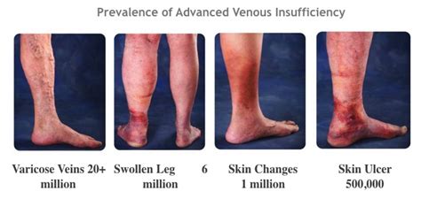 Varicose Veins Signs and Symptoms - Inovia Vein Specialty Center