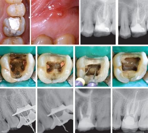 52-year-old man whose maxillary left first molar had been root ...