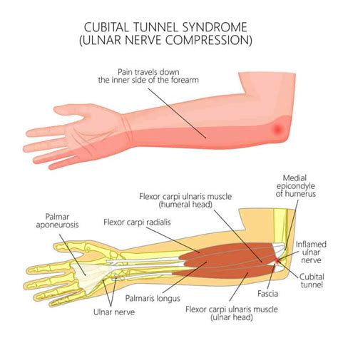 Elbow Conditions | Elbow Injuries | FORM Hand, Wrist & Elbow Institute