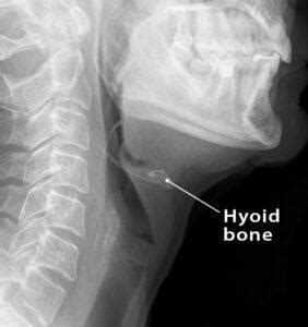 Hyoid Bone – Location, Functions, Anatomy, & Labeled Diagram