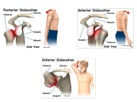 Shoulder Dislocation : Causes,Types,Symptoms & Treatment » How To Relief