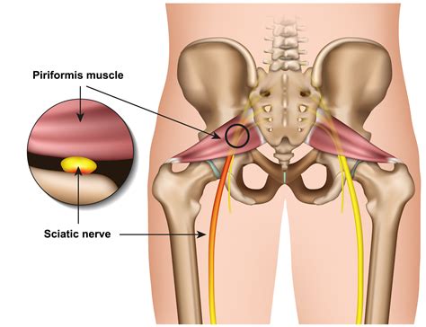 Fix Piriformis Syndrome With Resistance Bands