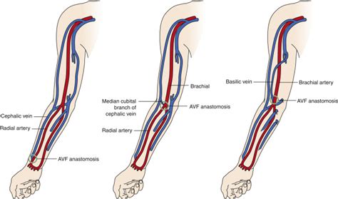 Dialysis Fistula