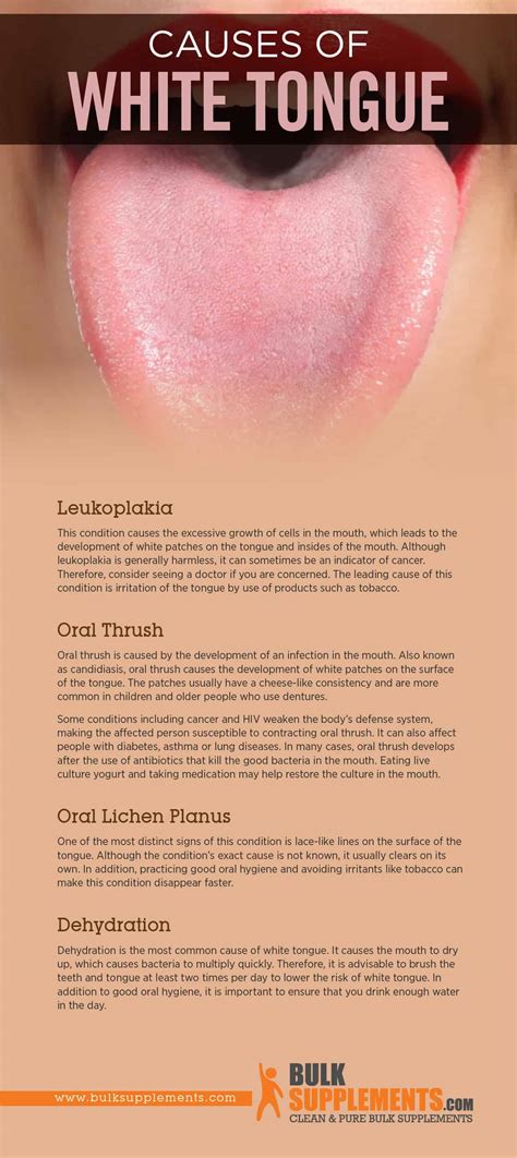 White Tongue: Symptoms, Causes & Treatment