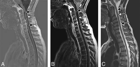 Cervical Spine Mri Ms