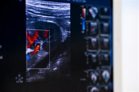 Mitral Valve Stenosis - News185