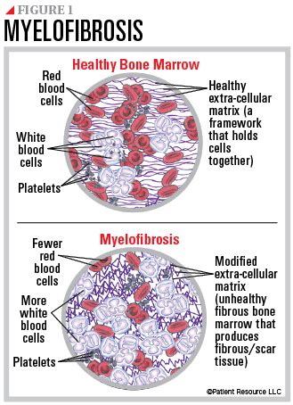 Myelofibrosis Overview