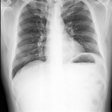 Benign Lung Nodules Identified Using Proteomic Biomarker - Pulmonology ...