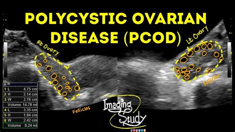 Normal Vs Polycystic Ovaries Ultrasound