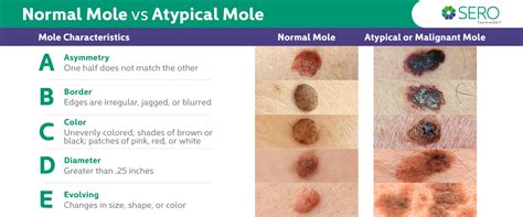 Melanoma - ZohebAmaryss