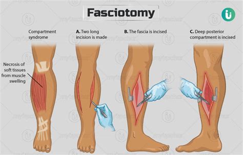 Fasciotomy: Procedure, Purpose, Results, Cost, Price