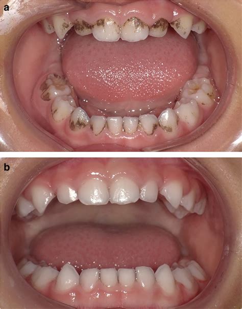 Denti macchiati di nero: cause e trattamenti - Studio Mazzei & Partners