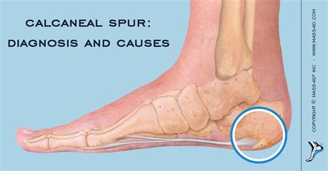 Plantar Calcaneal Spur Treatment