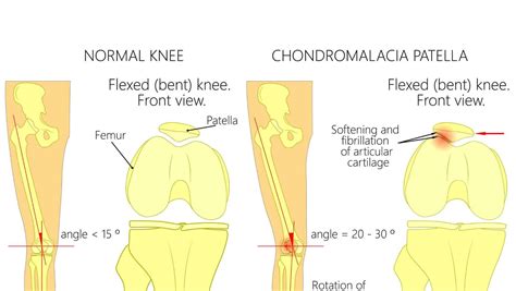 Chondromalacia Patella | Chondrosis of the Knee