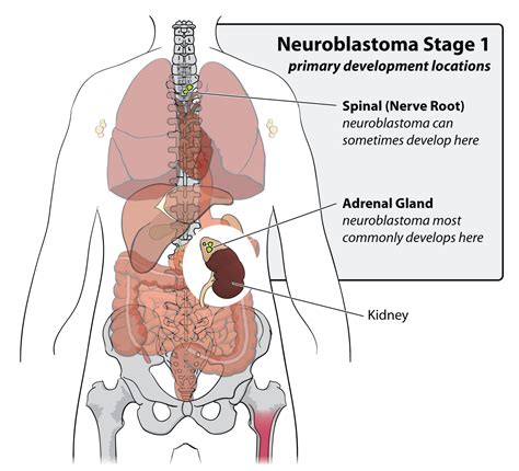 Neuroblastoma - Endocrine - Medbullets Step 1