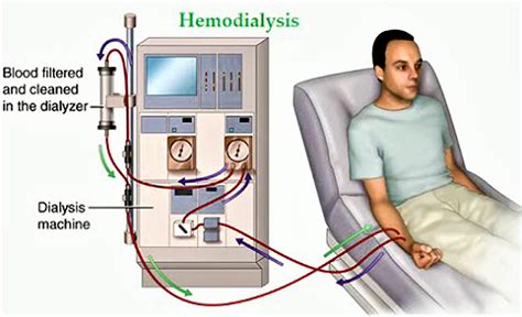 Hemodialysis - Procedure, Hemodialysis Side Effects