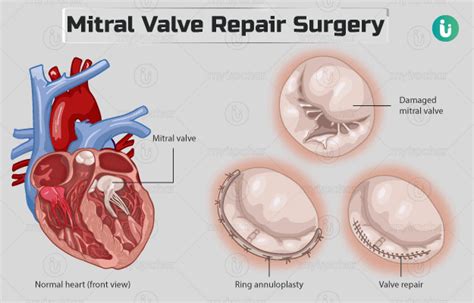 Mitral valve repair surgery: Procedure, Purpose, Results, Cost, Price