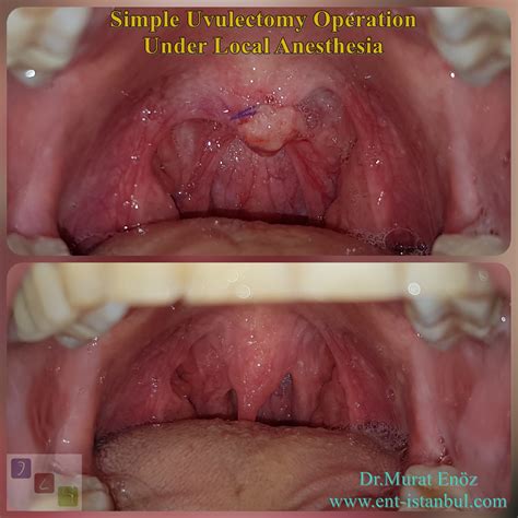 Elongated (Long) Uvula Causes, Symptoms and Treatment