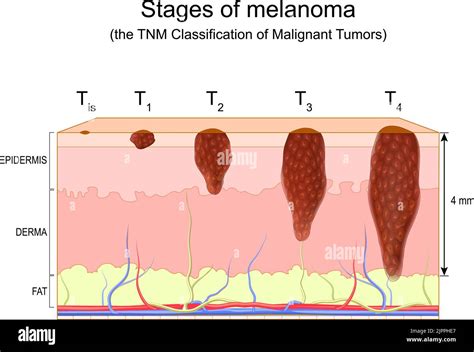 stages of melanoma. The TNM Classification of Malignant Tumors ...