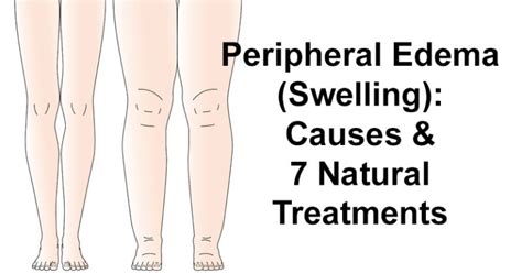 Peripheral Edema (Swelling): Causes & 7 Natural Treatments - David ...