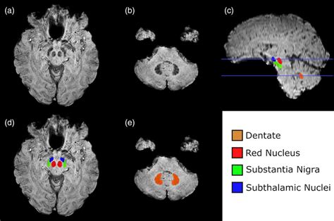 Dentate, red nucleus, substantia nigra, subthalamic nuclei visible as ...