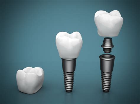 N Frisco TX, Frisco Oral And Dental Implant Surgery