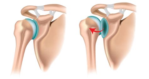 Posterior Shoulder Dislocation - Sportsinjuryclinic.net