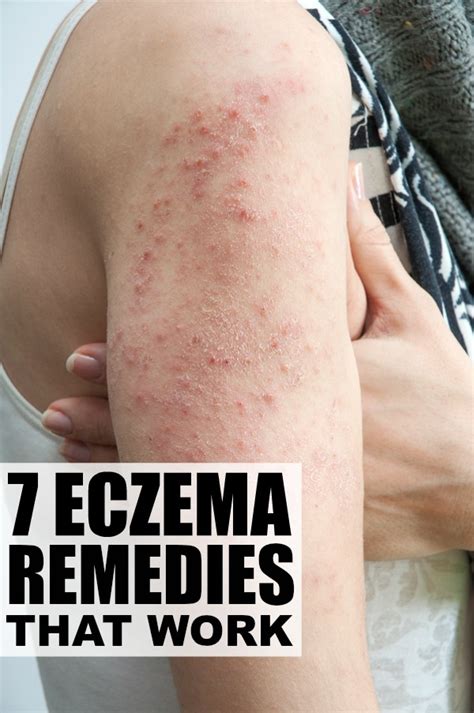 What causes eczema flare ups - indianlockq