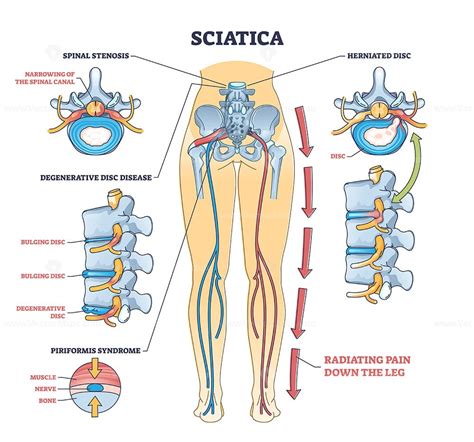 Sciatica pain or nerve weakness as leg lumbar radiculopathy outline ...